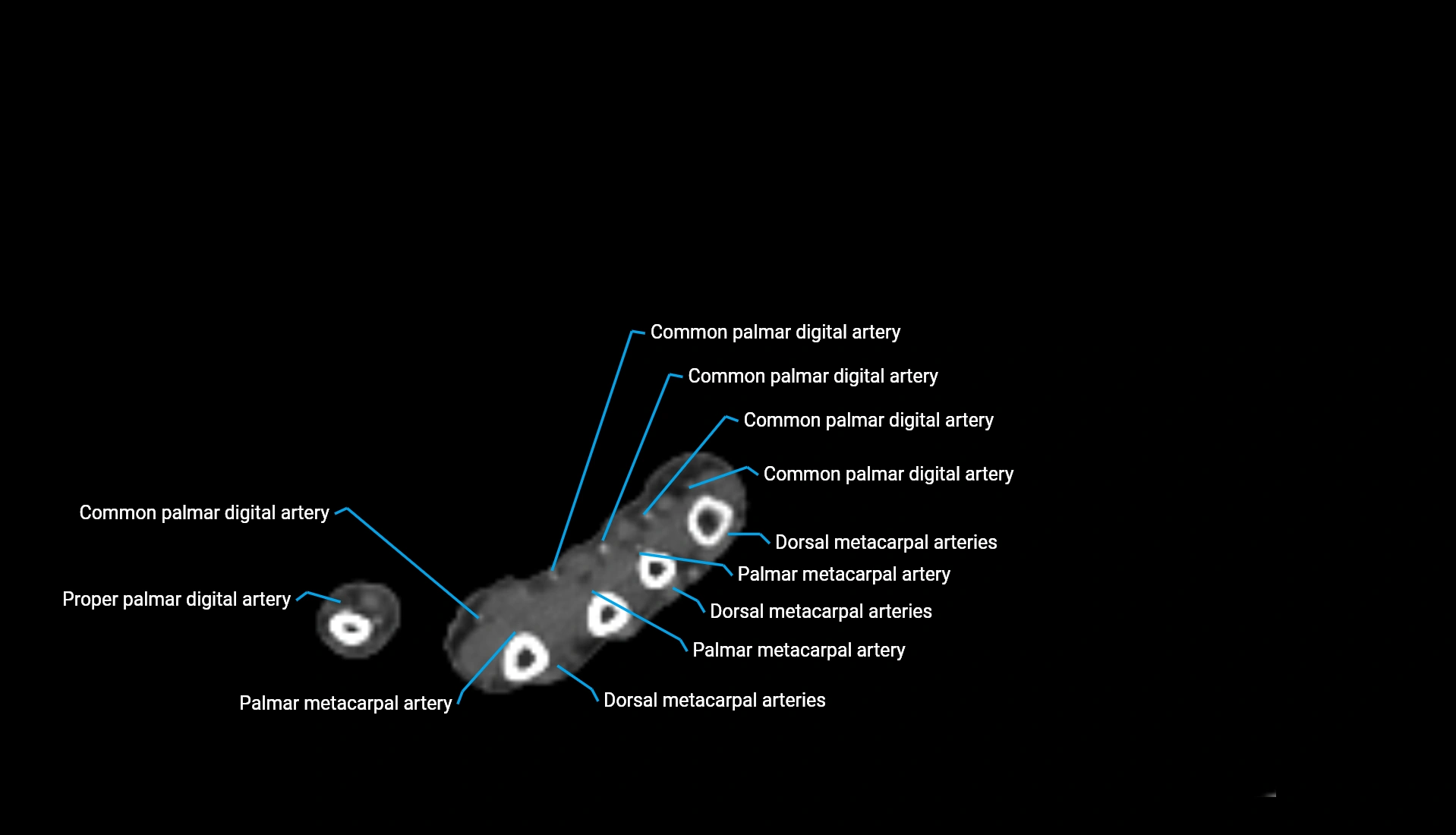 CTA upper limb axial cross sectional anatomy labelled image 52 (2).webp